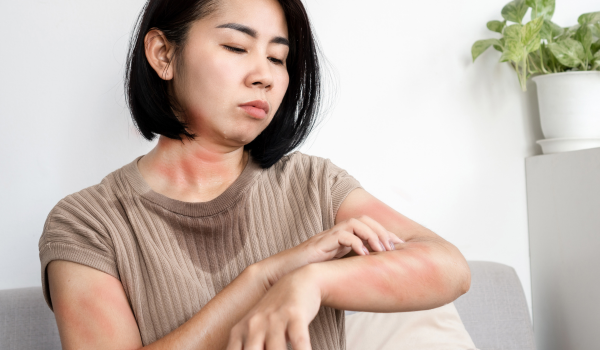 Can Stress Cause Rashes or Hives? Symptoms and Treatments